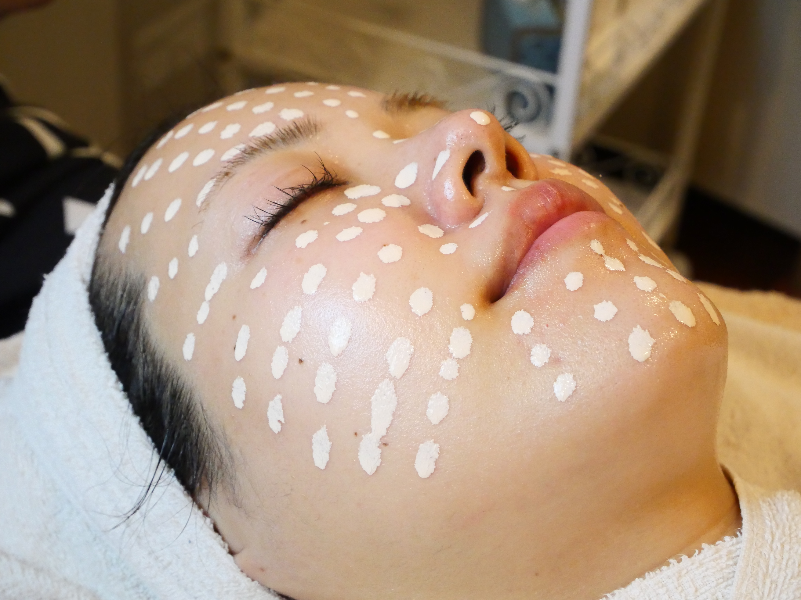 Meso Skin Color施術